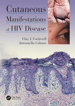 Hardcover Cutaneous Manifestations of HIV Disease Book