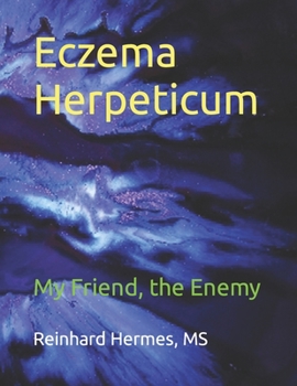 Paperback Eczema Herpeticum: My Friend, the Enemy Book