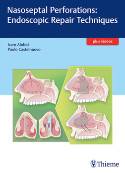 Hardcover Nasoseptal Perforations: Endoscopic Repair Techniques Book
