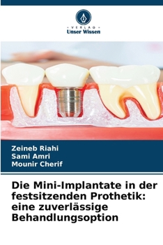Paperback Die Mini-Implantate in der festsitzenden Prothetik: eine zuverlässige Behandlungsoption [German] Book