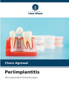 Paperback Periimplantitis [German] Book