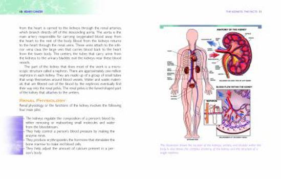 Library Binding Kidney Cancer Book