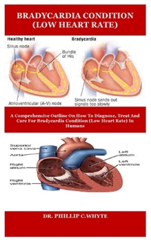 BRADYCARDIA CONDITION (LOW HEART RATE): A COMPREHENSIVE OUTLINE ON HOW TO DIAGNOSE, TREAT AND CARE FOR BRADYCARDIA CONDITION (LOW HEART RATE) IN HUMANS