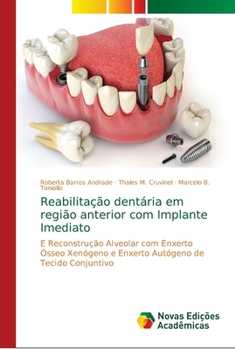 Paperback Reabilitação dentária em região anterior com Implante Imediato [Portuguese] Book