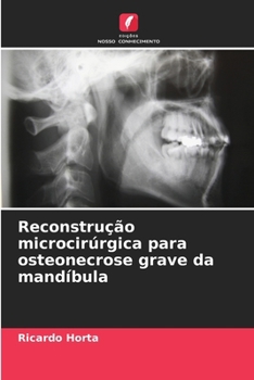 Paperback Reconstrução microcirúrgica para osteonecrose grave da mandíbula [Portuguese] Book