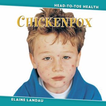 Library Binding Chickenpox Book