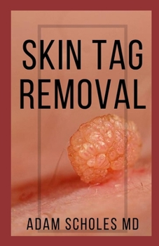 Paperback Skin Tag Removal: All You Need To Know About Methods of removing Mole, Wart and Skin Tag Naturally Book