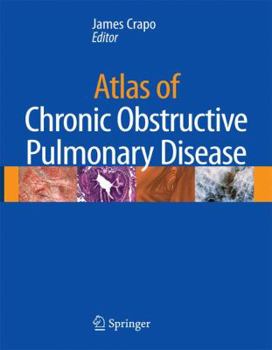Hardcover Atlas of Chronic Obstructive Pulmonary Disease Book