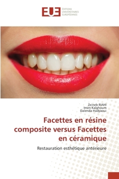 Facettes en résine composite versus Facettes en céramique (French Edition)