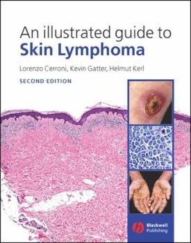Library Binding An Illustrated Guide to Skin Lymphoma Book