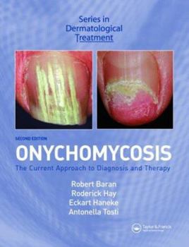 Hardcover Onychomycosis: The Current Approach to Diagnosis and Therapy (Series in Dermatological Treatment) Book