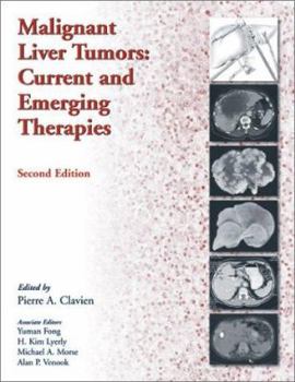 Hardcover Malignant Liver Tumors: Current and Emerging Therapies Book