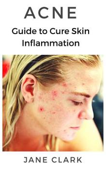 Paperback Acne: Guide to Cure Skin Inflammation Book