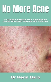 Paperback No More Acne: A Complete Handbook With The Symptom, Causes, Prevention Diagnosis And Treatment Book