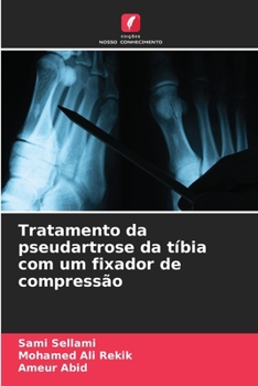 Paperback Tratamento da pseudartrose da tíbia com um fixador de compressão [Portuguese] Book