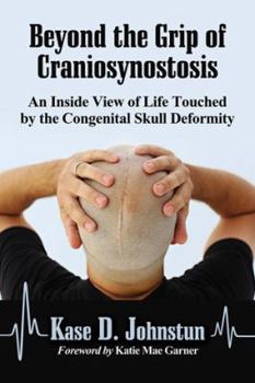 Paperback Beyond the Grip of Craniosynostosis: An Inside View of Life Touched by the Congenital Skull Deformity Book