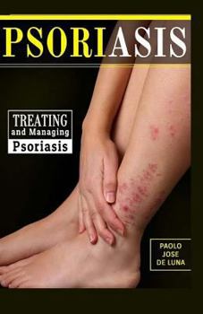 Paperback Psoriasis: Treating and Managing Psoriasis Book