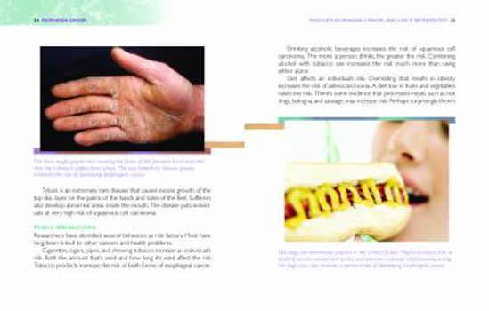 Esophageal Cancer