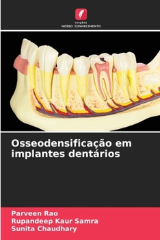 Osseodensificação em implantes dentários (Portuguese Edition)