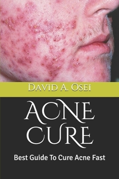 Paperback Acne Cure: Best Guide To Cure Acne Fast Book