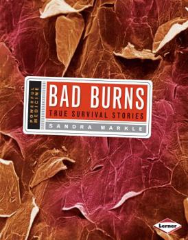 Library Binding Bad Burns: True Survival Stories Book