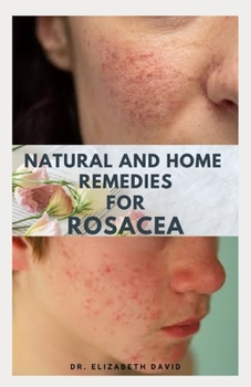 Paperback Natural and Home Remedies for Rosacea: A Self Help Guide To Completely Prevent and Treat Rosacea Book