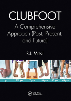 Paperback Clubfoot: A Comprehensive Approach (Past, Present, and Future) Book
