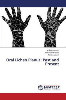 Paperback Oral Lichen Planus: Past and Present Book