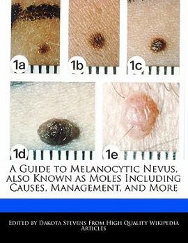 Paperback A Guide to Melanocytic Nevus, Also Known as Moles Including Causes, Management, and More Book