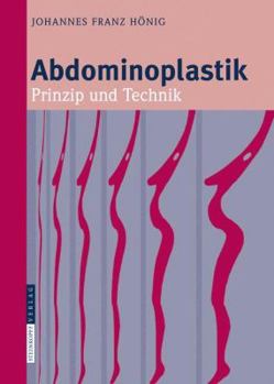 Abdominoplastik: Prinzip Und Technik
