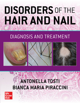 Hardcover Disorders of the Hair and Nail: Diagnosis and Treatment Book