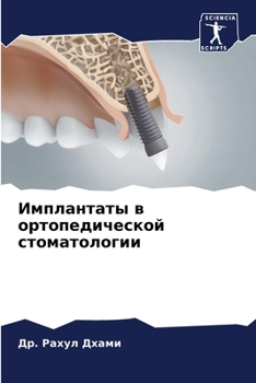 Paperback Имплантаты в ортопедиче& [Russian] Book