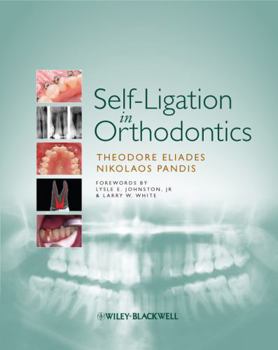 SELF-LIGATION IN ORTHODONTICS