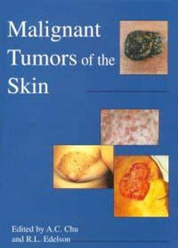 Hardcover Malignant Tumors of the Skin Book