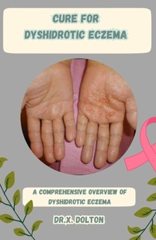 Paperback Cure for Dyshidrotic Eczema: A Comprehensive Overview of Dyshidrotic Eczema Book