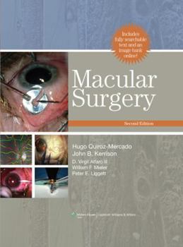 Hardcover Macular Surgery Book