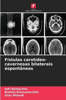 Paperback Fístulas carotídeo-cavernosas bilaterais espontâneas [Portuguese] Book