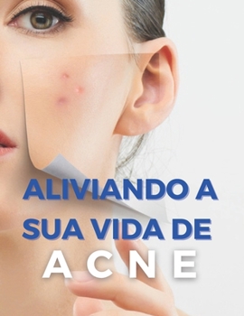 Paperback Aliviando Su Vida de Acné: Formas de Cuidar tu Acné - Formas Sencillas y Probadas [Spanish] Book
