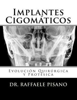 Paperback Implantes Cigomáticos: Evolución Quirúrgica y Protésica [Spanish] Book