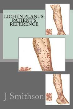 Paperback Lichen Planus: Patient's Reference Book