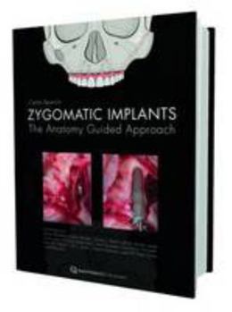 Hardcover Zygomatic Implants: The Anatomy-Guided Approach Book