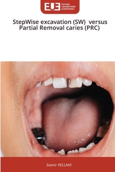 Paperback StepWise excavation (SW) versus Partial Removal caries (PRC) [French] Book