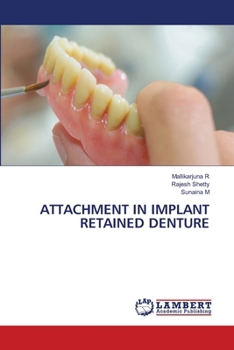 Paperback Attachment in Implant Retained Denture Book