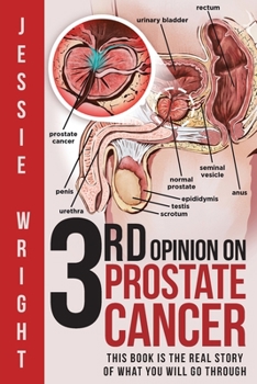 Paperback 3rd Opinion on Prostate Cancer Book