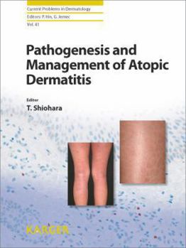 Hardcover Pathogenesis and Management of Atopic Dermatitis (Current Problems in Dermatology) Book
