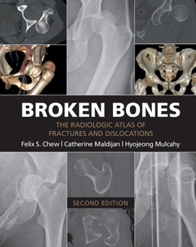 Paperback Broken Bones: The Radiologic Atlas of Fractures and Dislocations Book