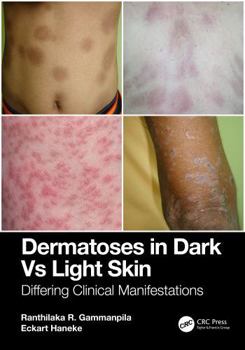 Paperback Dermatoses in Dark Vs Light Skin: Differing Clinical Manifestations Book