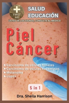 Piel Cáncer: Carcinoma de células basales, carcinoma de células escamosas, cáncer de piel melanoma, lunar: Tipos, Síntomas, Causas, Diagnóstico, ... SIGNOS, USTED VE AL MÉDICO) (Spanish Edition)