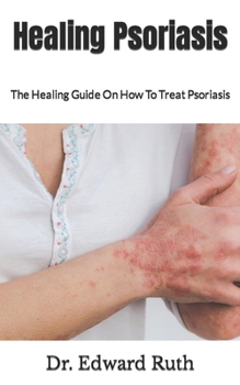 Paperback Healing Psoriasis: The Healing Guide On How To Treat Psoriasis Book