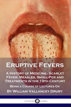 Eruptive Fevers: A History of Medicine - Scarlet Fever, Measles, Small-Pox and Treatments in the 19th Century